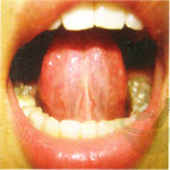 正常舌下络脉