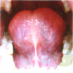 舌下络脉瘀紫曲张