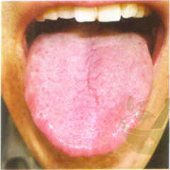 裂纹舌(形)