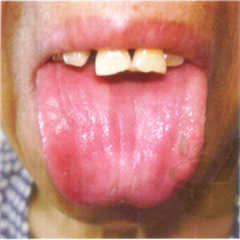 镜面舌和光滑舌(苔质)