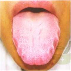 齿痕舌(形)